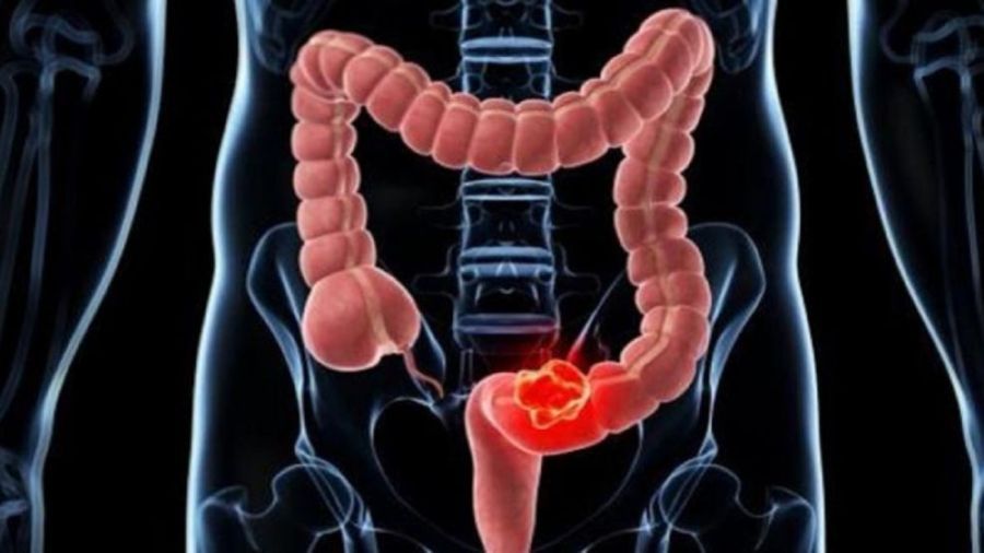 Cancer de colon