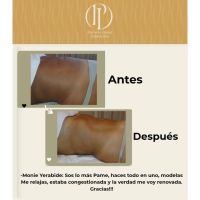 Descubre los secretos de la técnica P.L.A.S., la innovación en tratamientos reductores